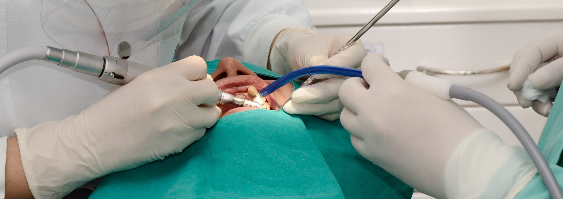 impianti dentali zigomatici